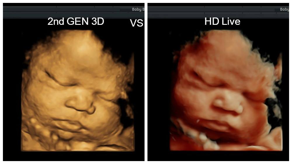 3d ultrasound how much