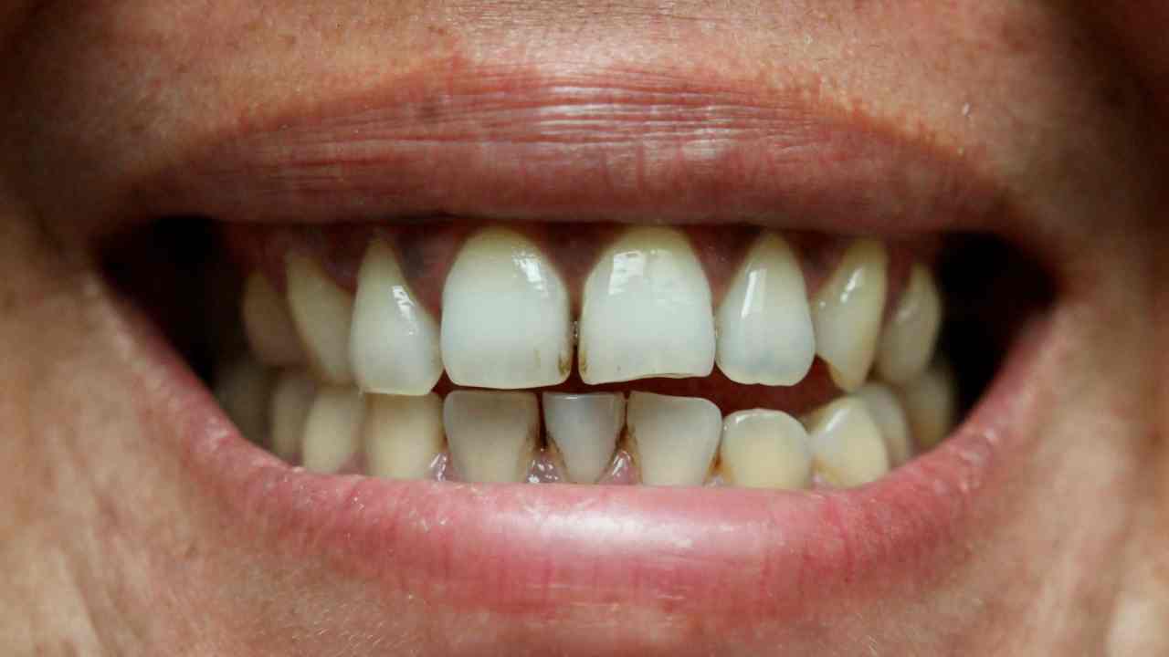 Black spots on teeth how to remove home remedies