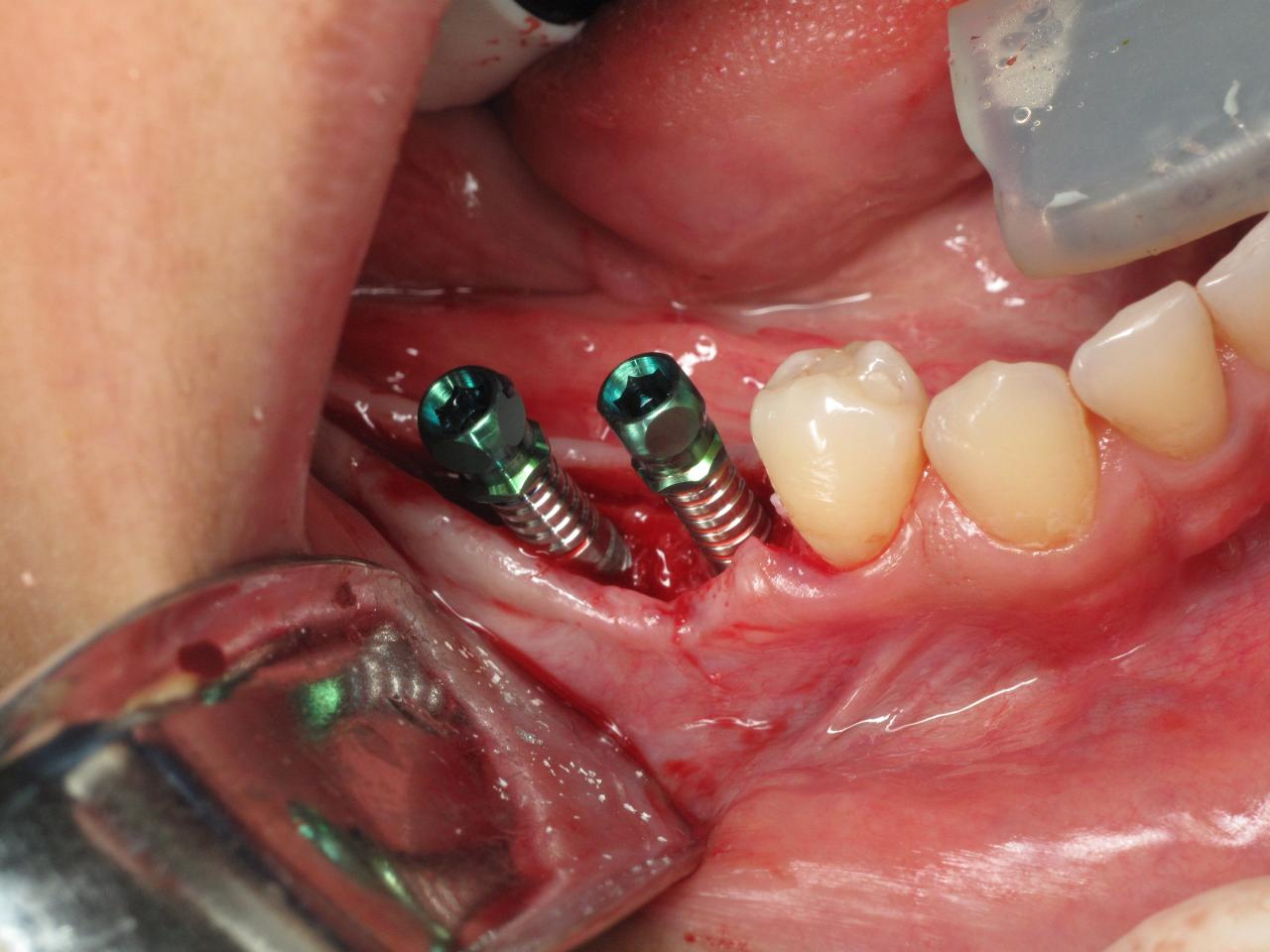 How are dental implants removed